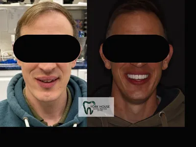 Smile transformation – 1