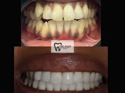 Smile transformation – 10