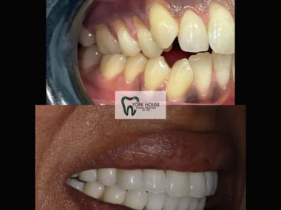 Smile transformation – 11