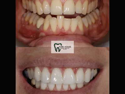 Smile transformation – 12
