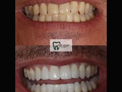Smile transformation – 13