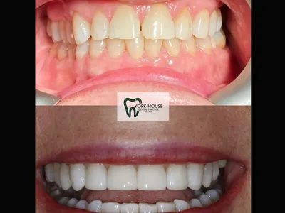 Smile transformation – 14