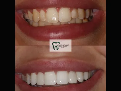 Smile transformation – 15