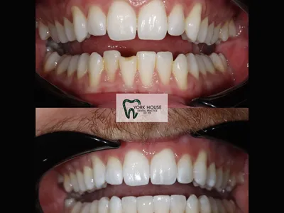 Smile transformation – 16