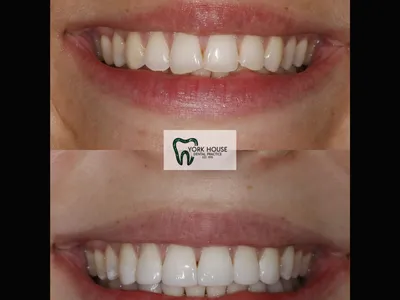 Smile transformation – 19