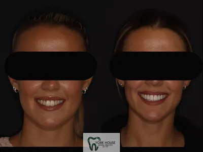 Smile transformation – 2