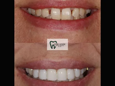 Smile transformation – 20
