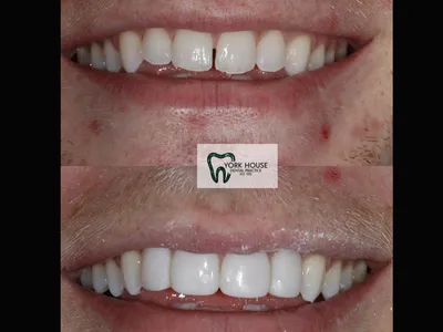 Smile transformation – 23