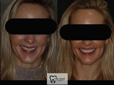 Smile transformation – 25
