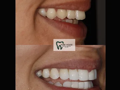 Smile transformation – 28
