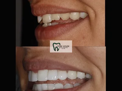 Smile transformation – 29