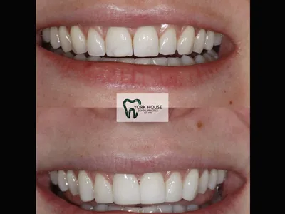 Smile transformation – 30