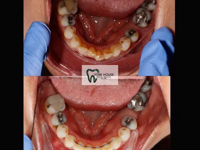 Smile transformation – 32