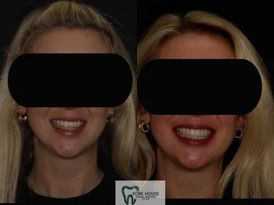 Smile transformation – 33