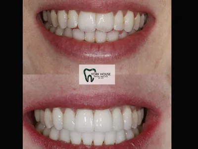 Smile transformation – 34