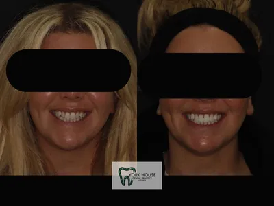 Smile transformation – 35