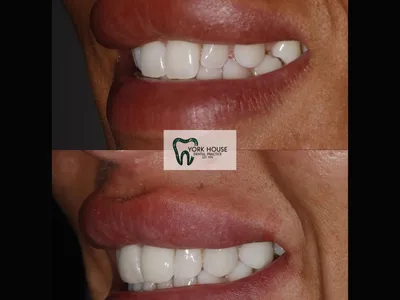 Smile transformation – 36