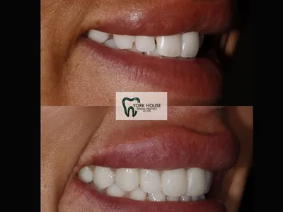 Smile transformation – 37