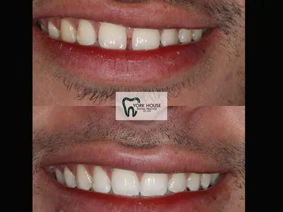 Smile transformation – 38