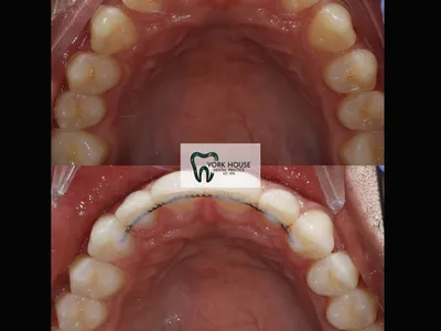 Smile transformation – 39