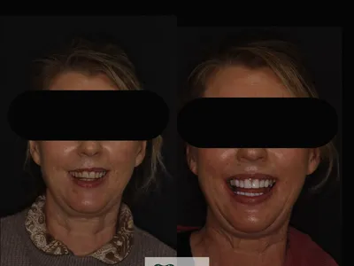 Smile transformation – 4