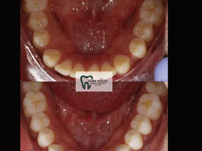 Smile transformation – 40