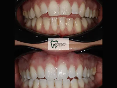 Smile transformation – 41