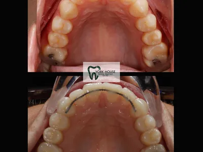 Smile transformation – 42