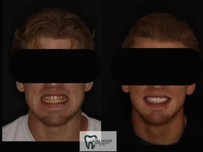 Smile transformation – 43