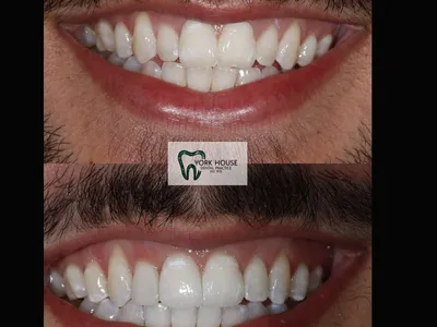 Smile transformation – 44