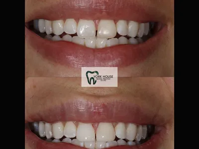 Smile transformation – 5