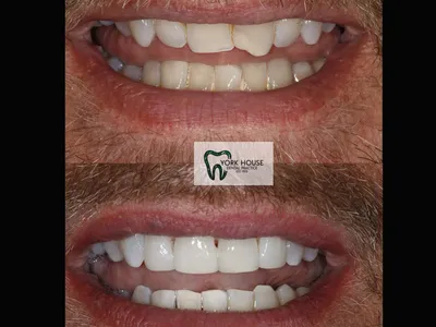 Smile transformation – 7