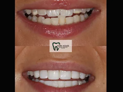 Smile transformation – AB-1