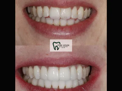 Smile transformation – AB-2