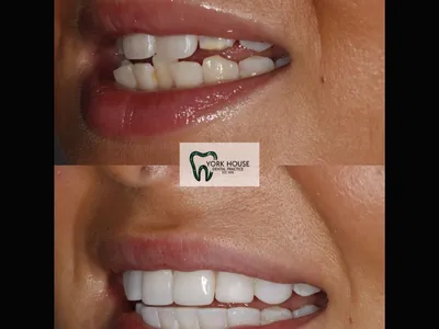 Smile transformation – AB-3