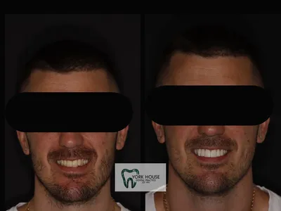 Smile transformation – AJ-1