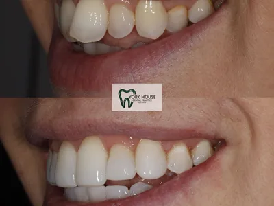 Smile transformation – AJ-2