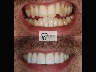 Smile transformation – AJ-3