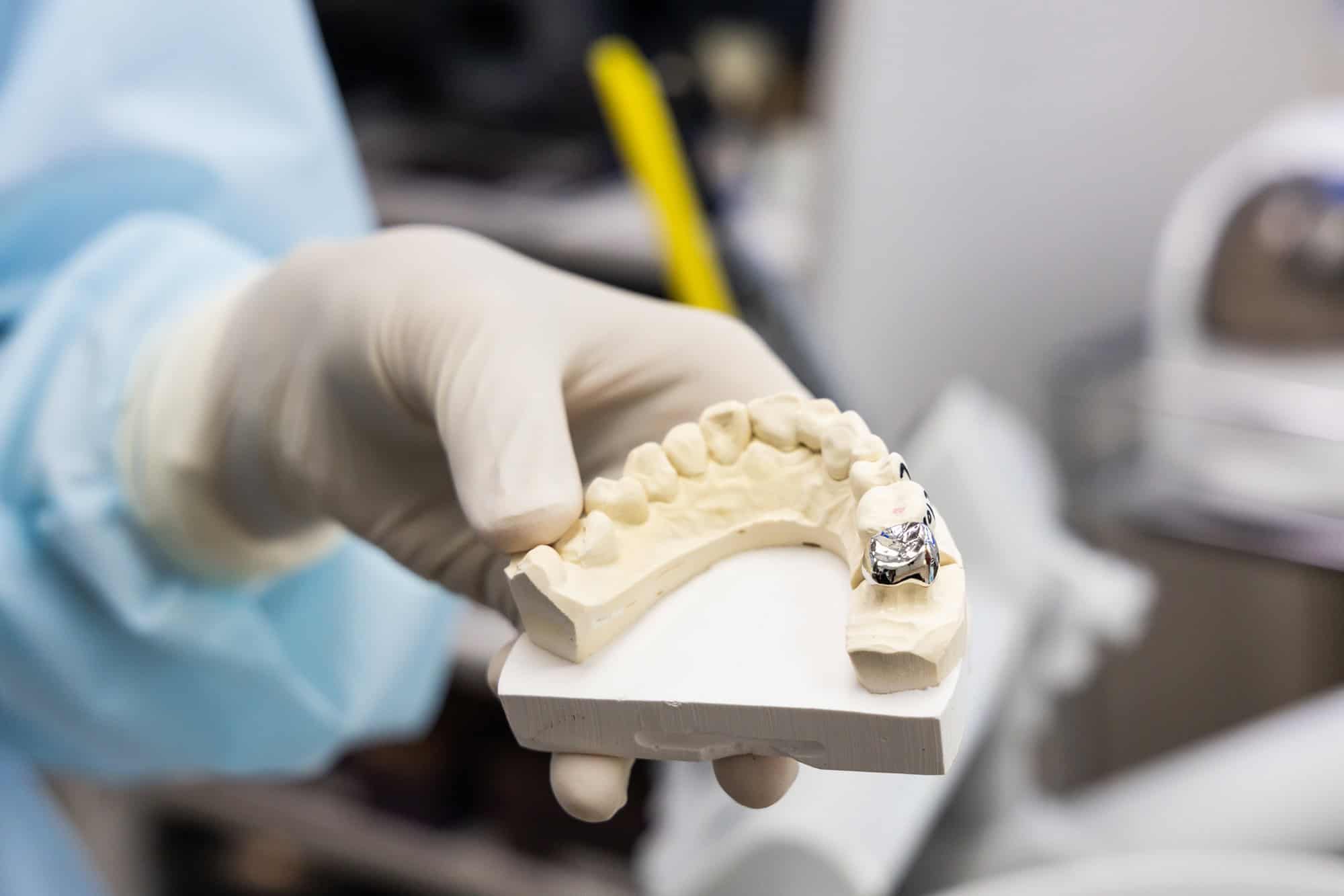 Dentist holding dental prosthesis imprint with metal crown on molar tooth